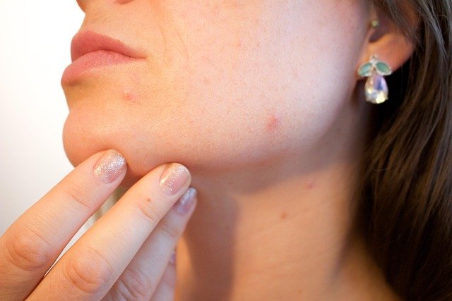 with-Acne